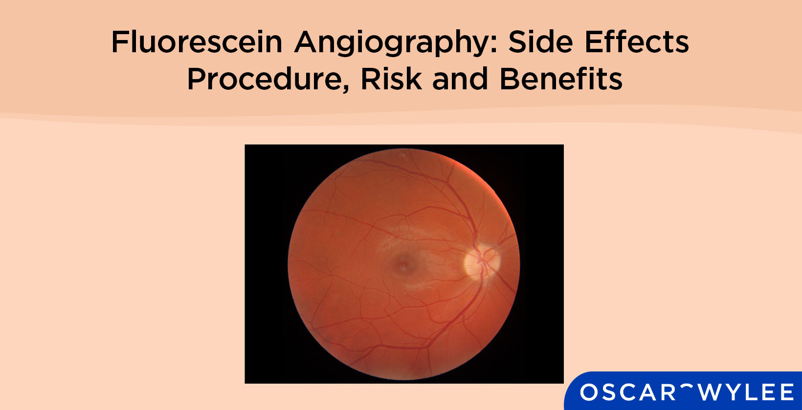 Fluorescein Angiography