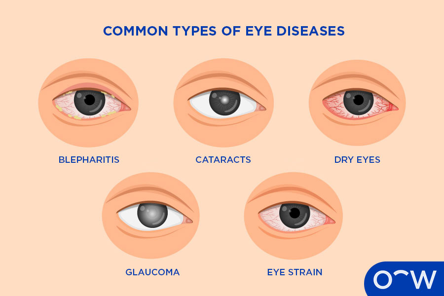 Diagram of different eyes that are affected by common types of eye diseases.