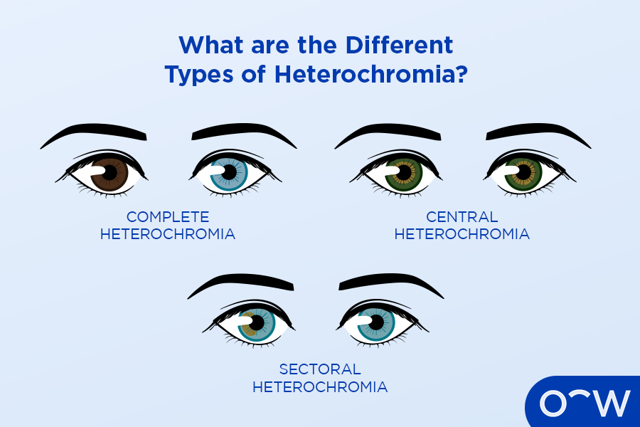 Three pictures of eyes, each with a type of heterochromia including complete heterochromia, central heterochromia and sectoral heterochromia.