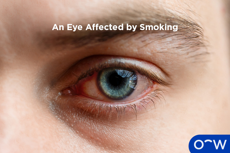 A man with an eye affected by smoking.