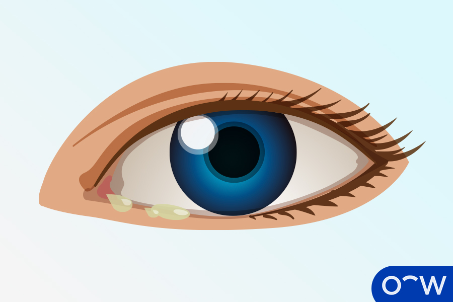An illustration of an eye with mucus of discharge around the eyelids and surrounding skin that needs to be cleaned.