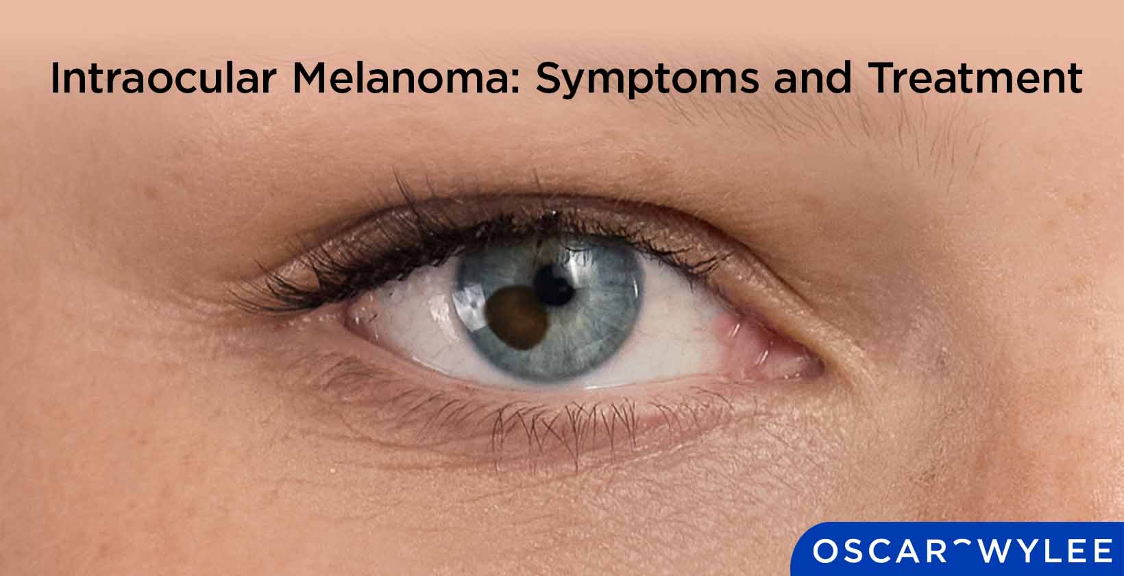 Intraocular Melanoma: Symptoms and Treatment