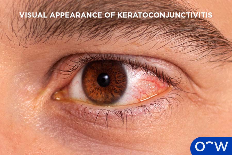 An eye with keratoconjunctivitis as indicated by redness, swelling and discharge
