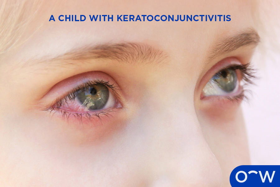 Child exhibiting some symptoms of keratoconjunctivitis with a red right eye, watery eyes and swelling.