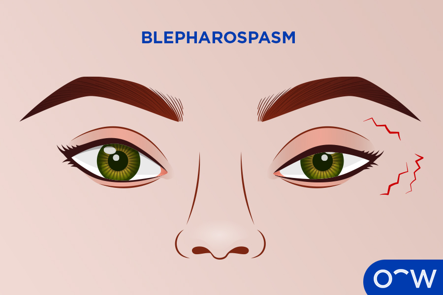 Eyes with red marks on eyelid, indicating twitching.