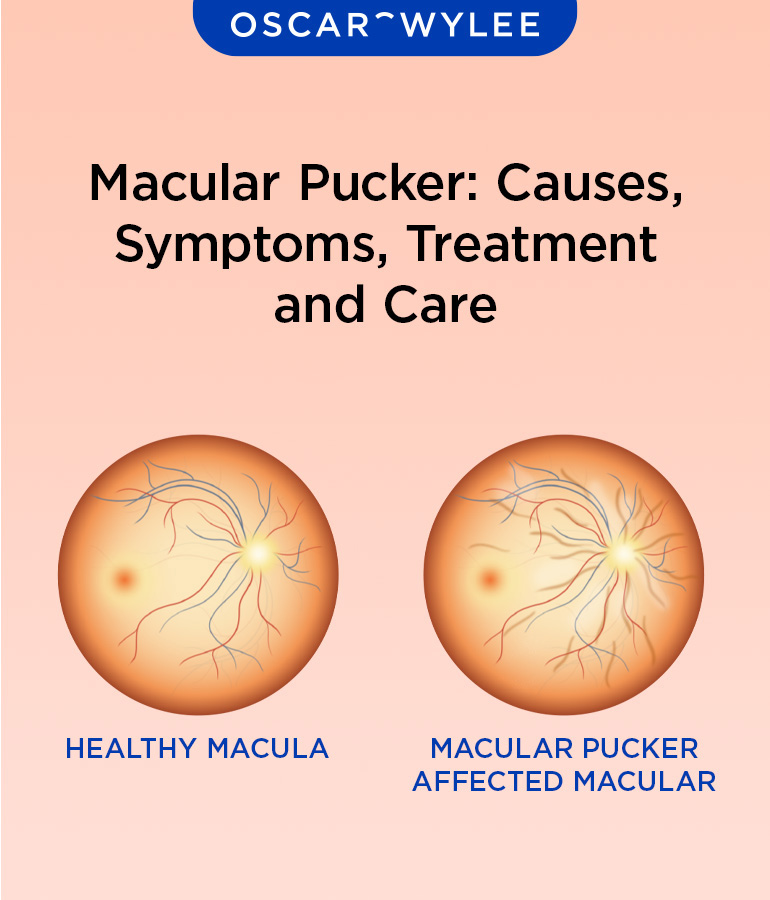 Macular Pucker