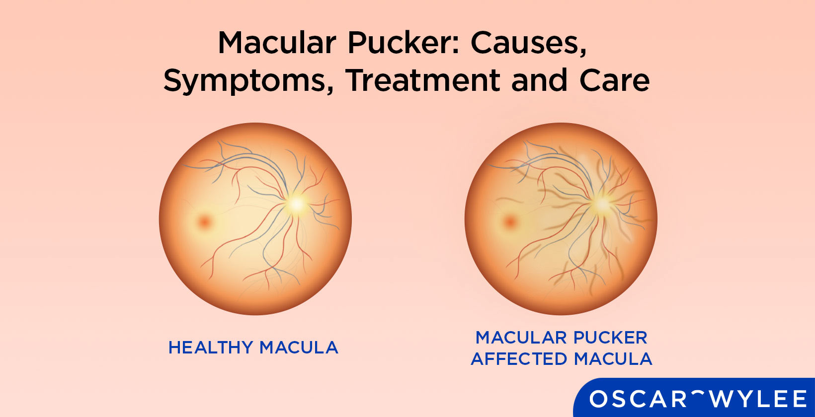 Macular Pucker
