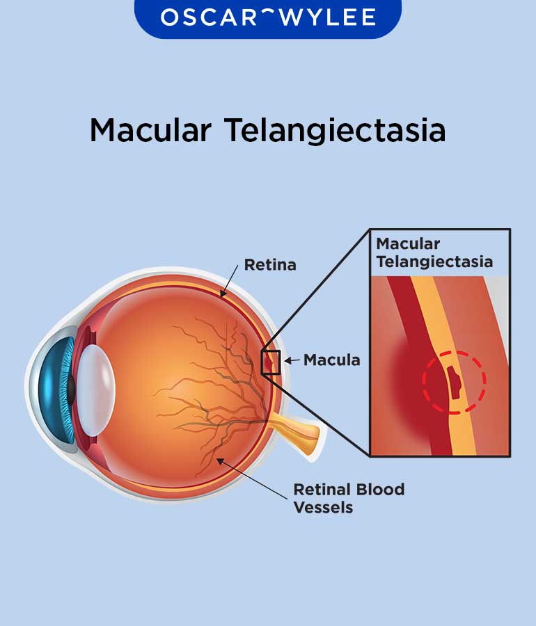 Macular Telangiectasia (MacTel): Type and Treatment
