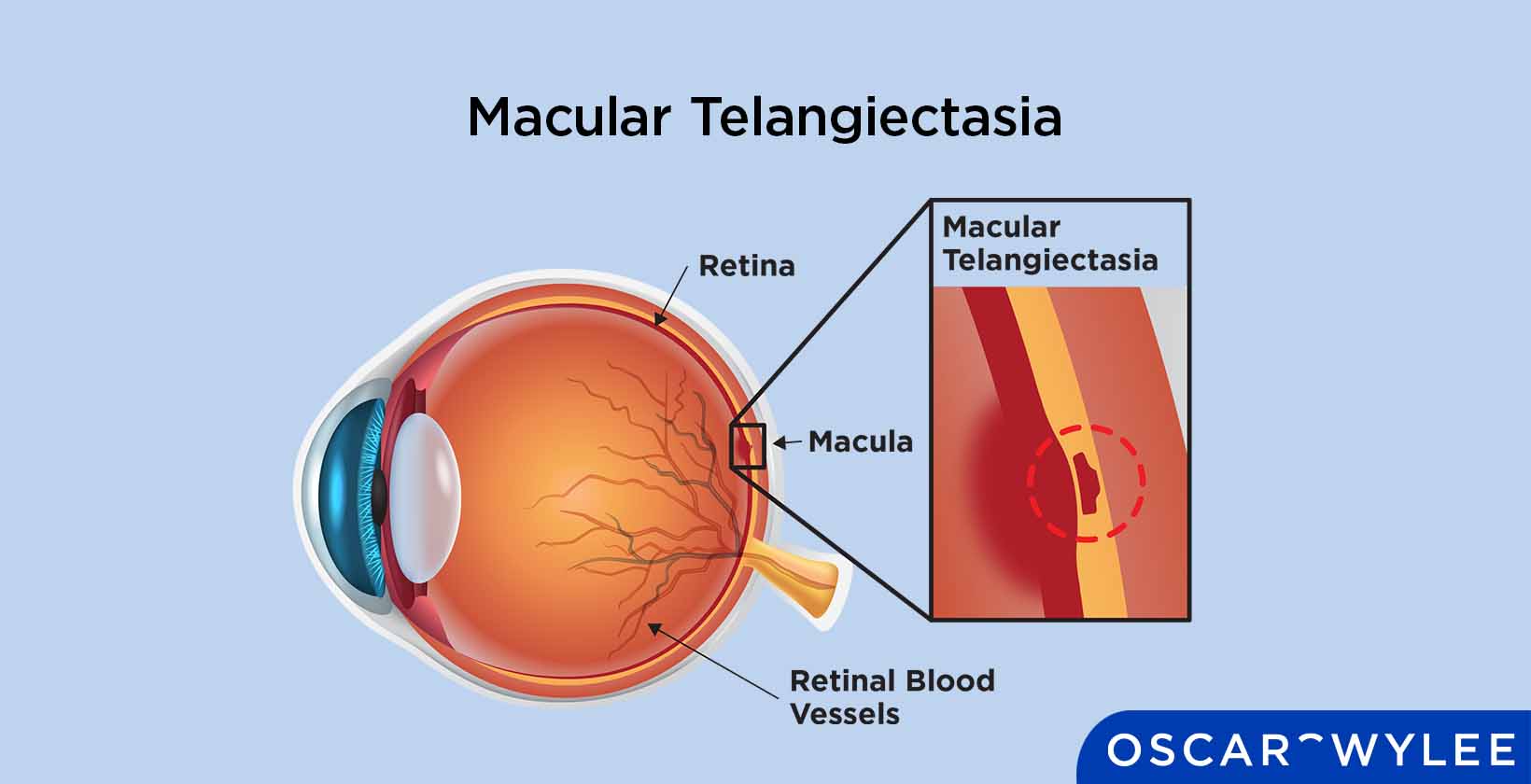Macular Telangiectasia (MacTel): Type and Treatment