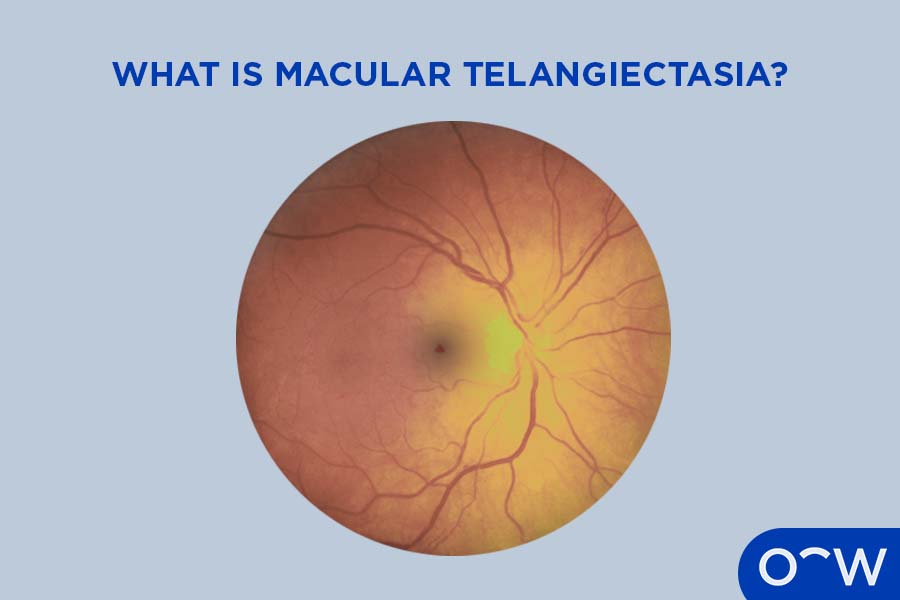 A fundus photograph displaying the retina.