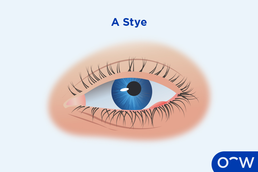 An eye with a stye on the lower lid.