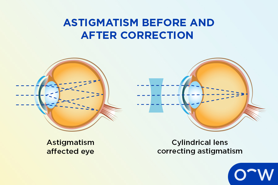 Diagram of how astigmatism affected eye processes light before and after lens correction