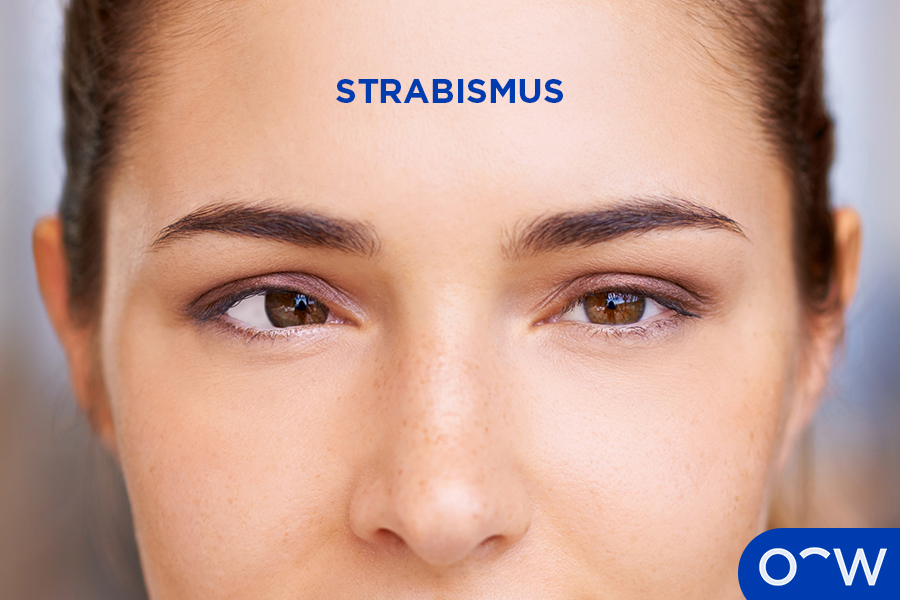 A woman’s eyes indicate strabismus with her right eye pointed inwards while her left eye is positioned in the centre.
