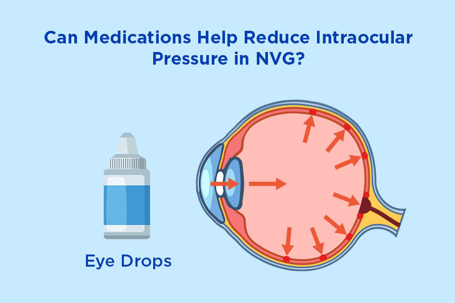 Graphic of the internal view of the eye and eye drops