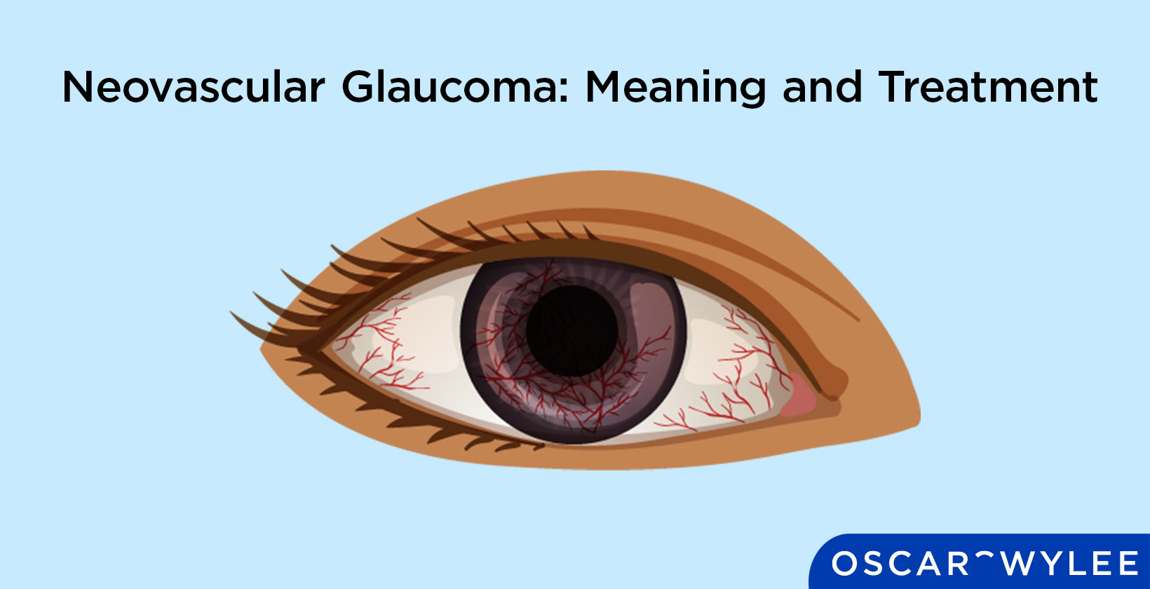 Neovascular Glaucoma: Meaning and Treatment