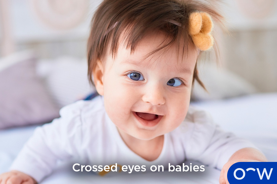 The image shows a baby with crossed eyes