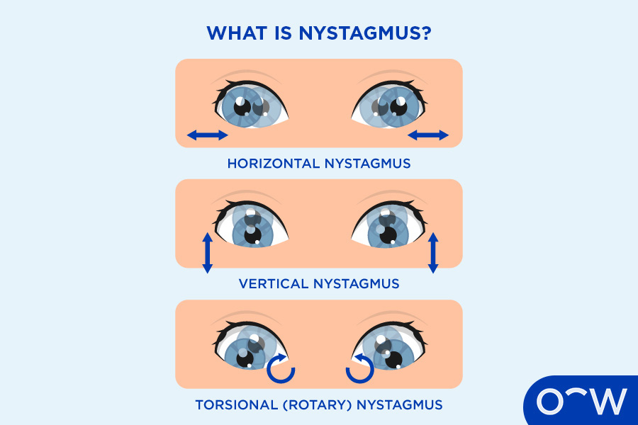 A graphic illustration showing what nystagmus is and the different ways the eyes move depending on the type.