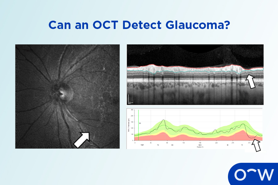 OCT scan of the back of the eye that can help an optometrist detect glaucoma.