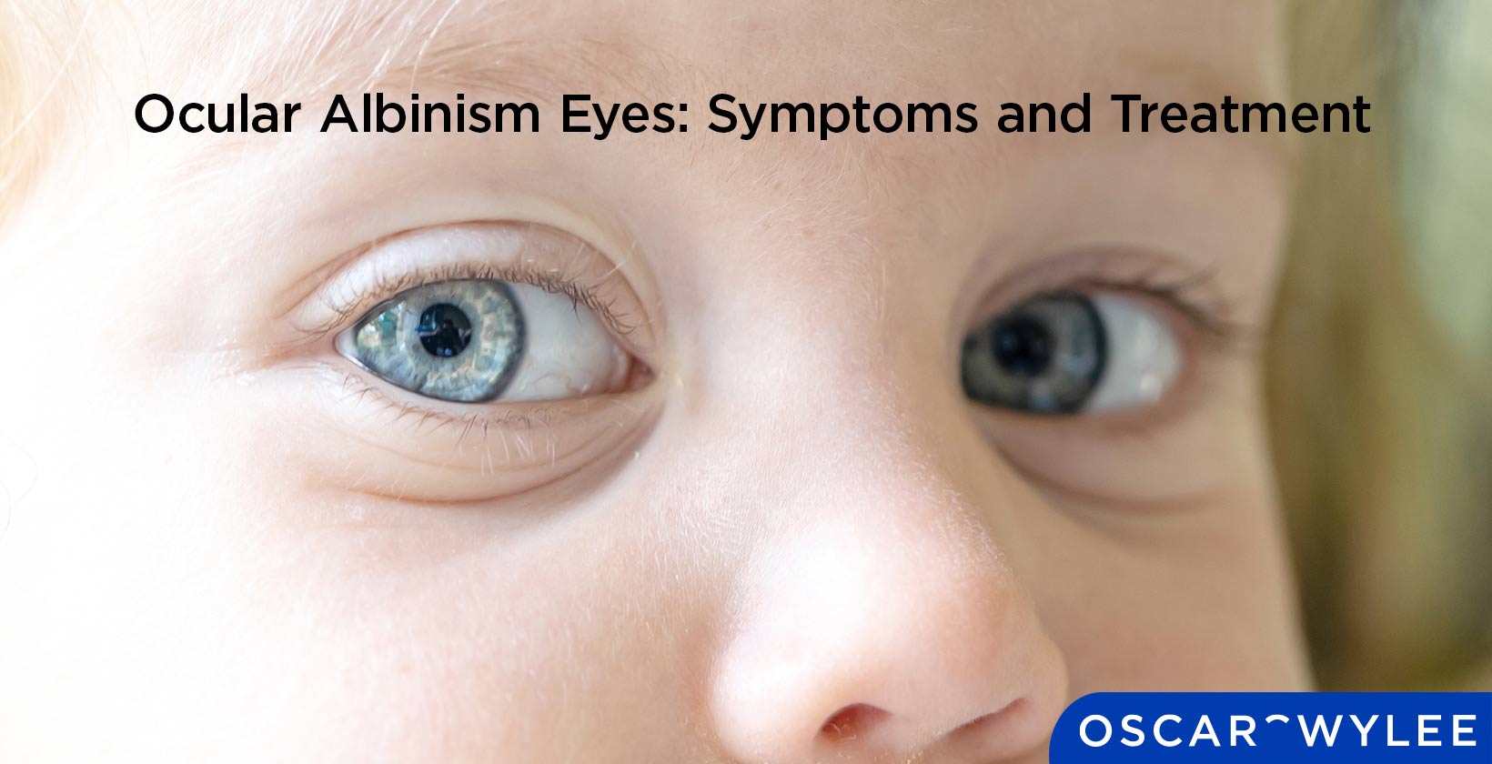 Ocular Albinism Eyes: Symptoms and Treatment