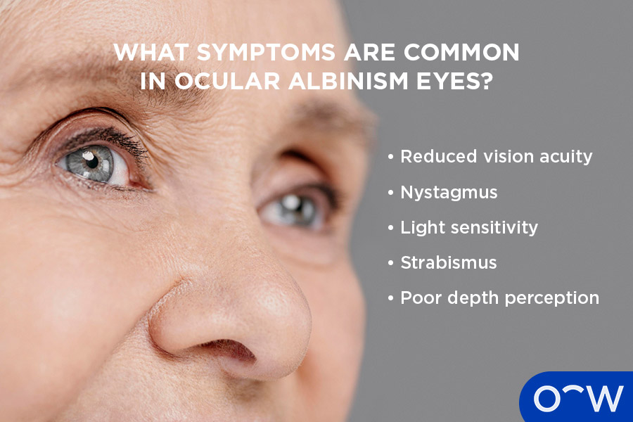 An infographic showing eyes affected by ocular albinism with symptoms listed to the side: reduced vision acuity, nystagmus, light sensitivity, strabismus and poor depth perception.