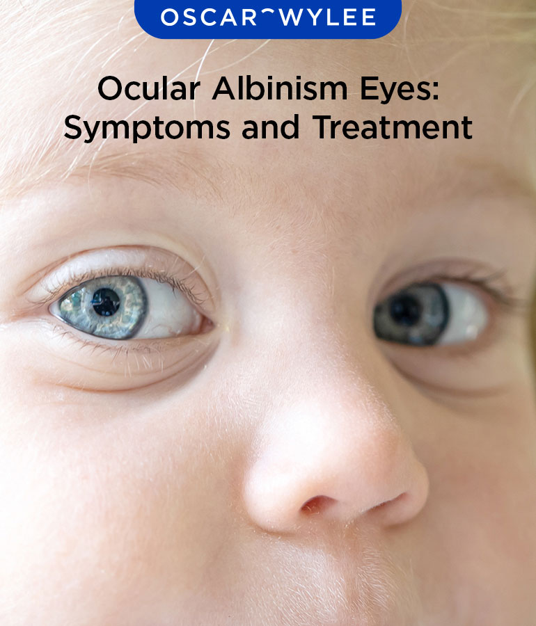 Ocular Albinism Eyes: Symptoms and Treatment