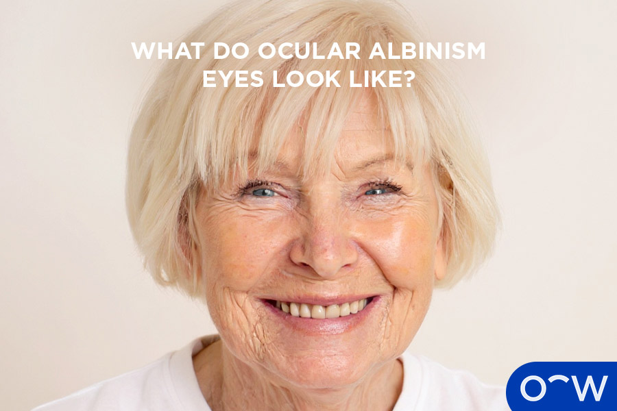 A photo of what eyes affected by Ocular Albinism look like.