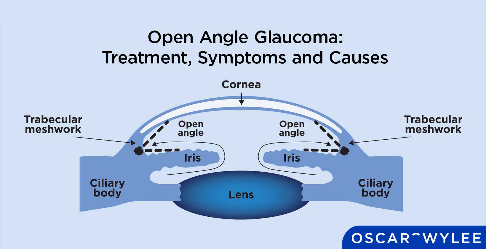 Open Angle Glaucoma: Treatment, Symptoms and Causes