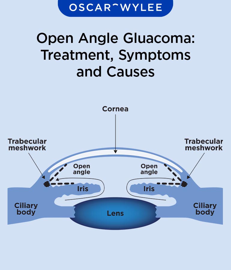 Open Angle Glaucoma: Treatment, Symptoms and Causes