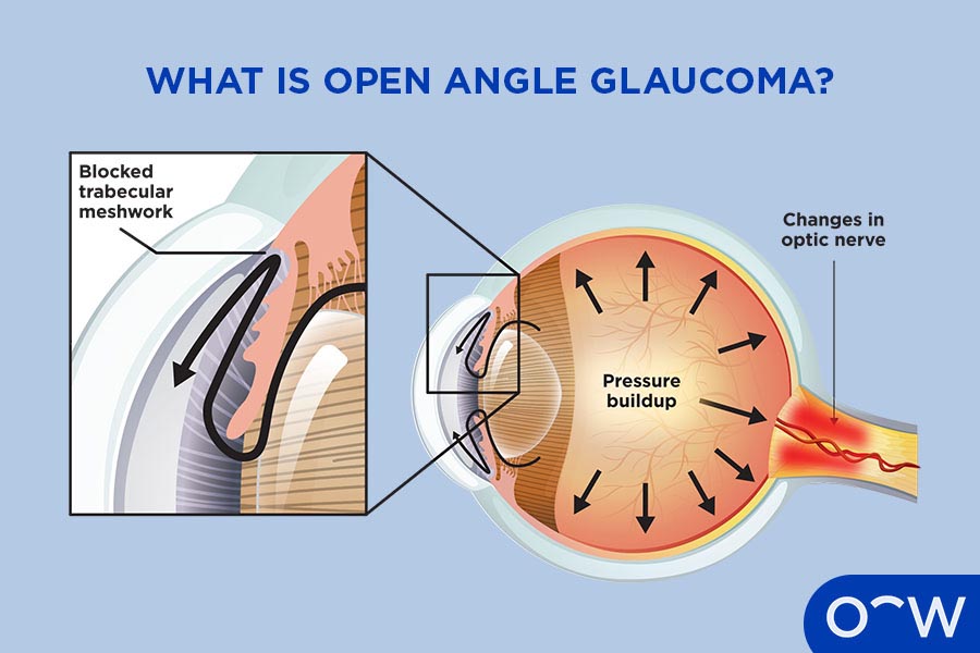 Labelled graphic explaining what open angle glaucoma is on an eyeball