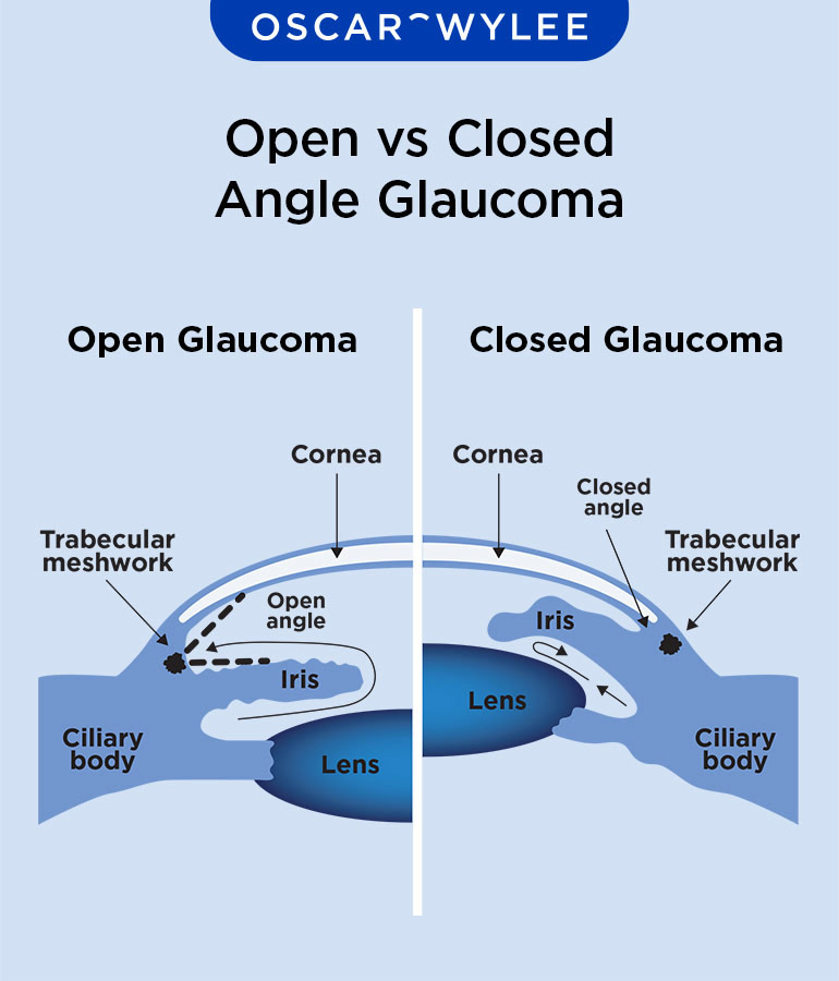 Open vs Closed Angle Glaucoma