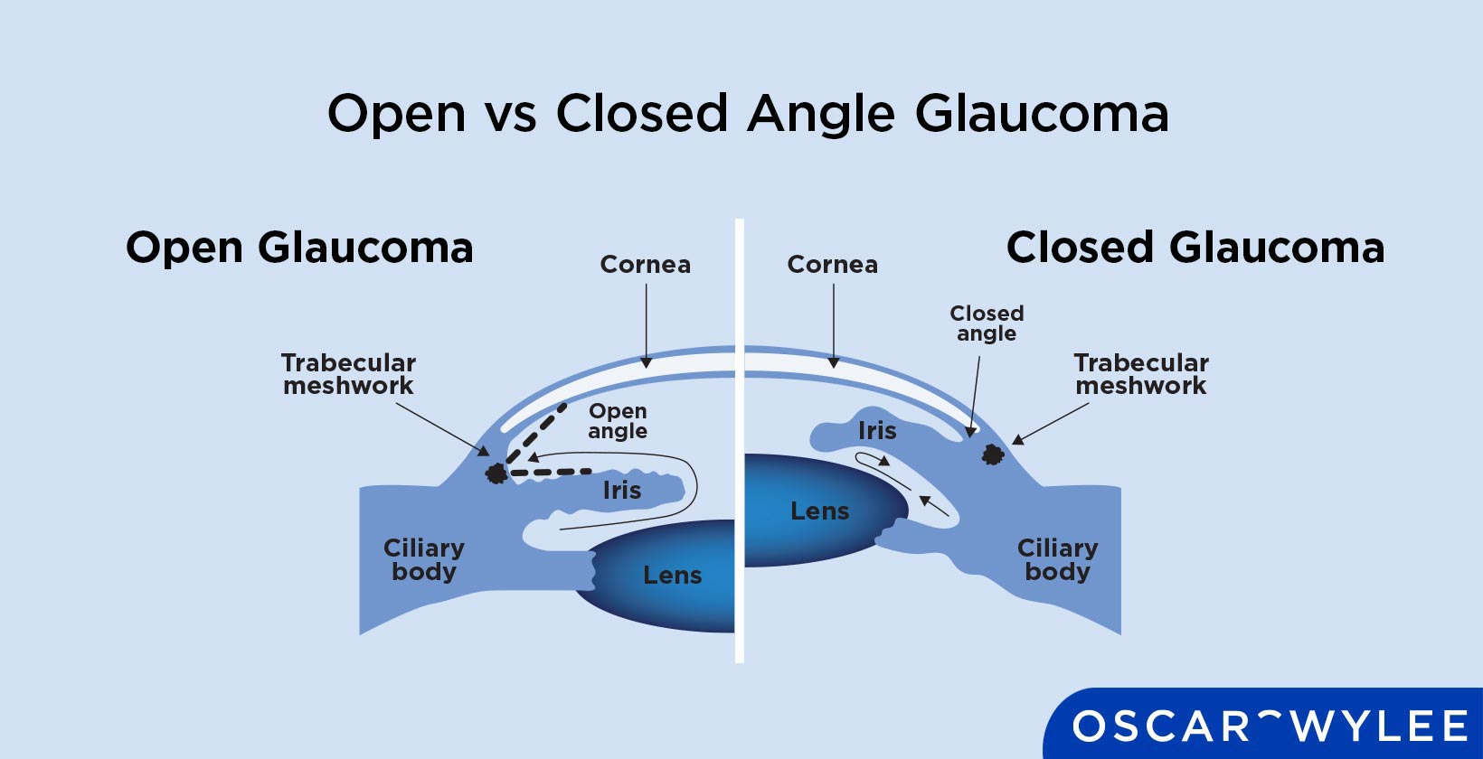 Open vs Closed Angle Glaucoma