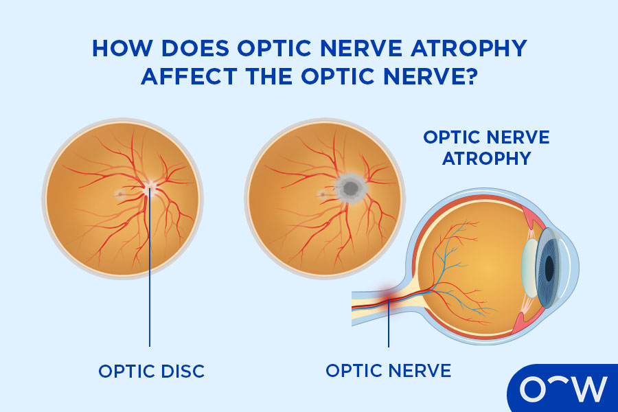 Inside the eye showing a normal optic disk and a pale optic disk.