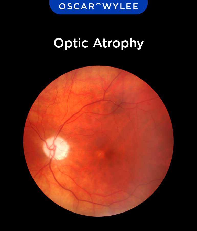 Optic Atrophy: Meaning, Causes and Treatment