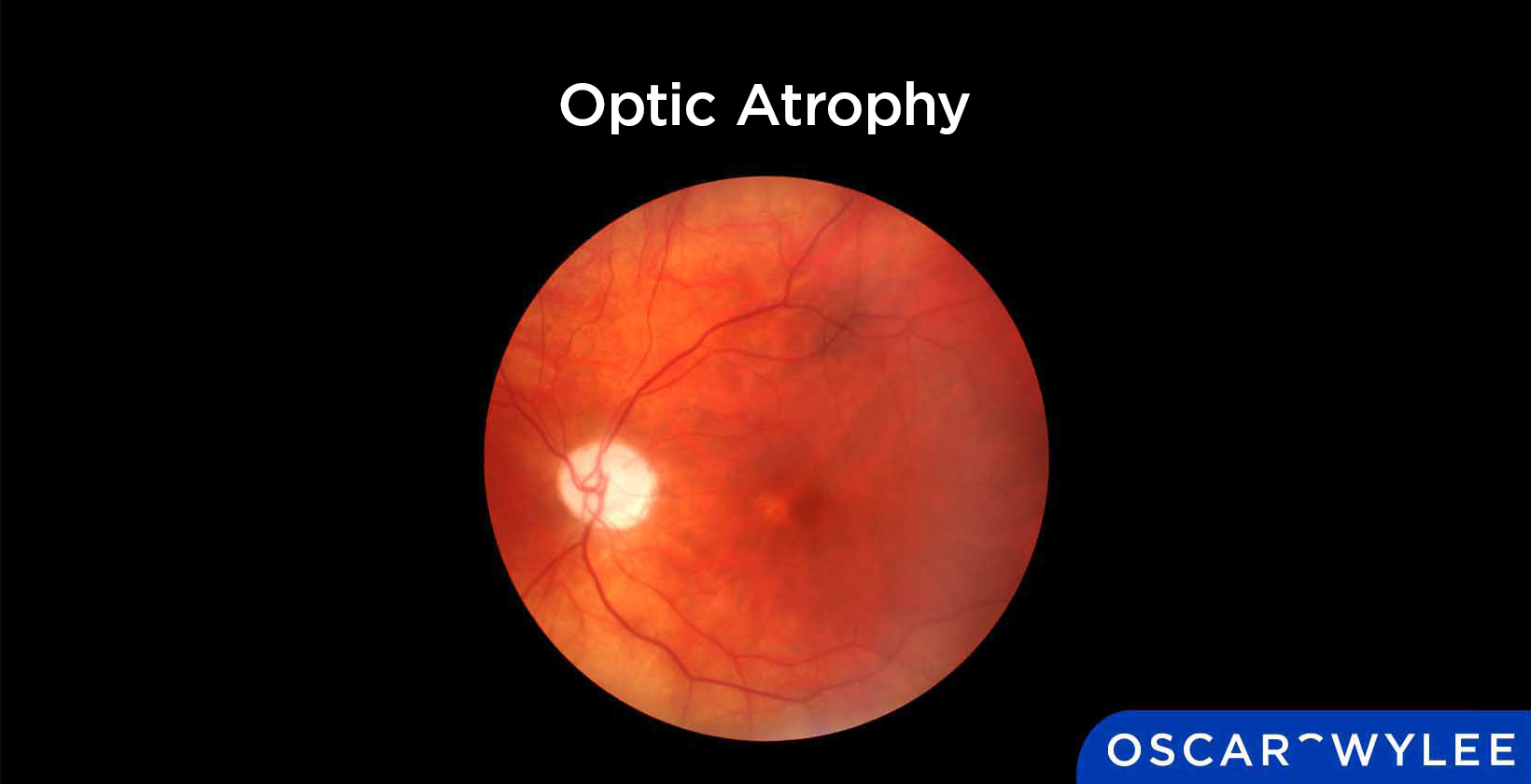 Optic Atrophy: Meaning, Causes and Treatment
