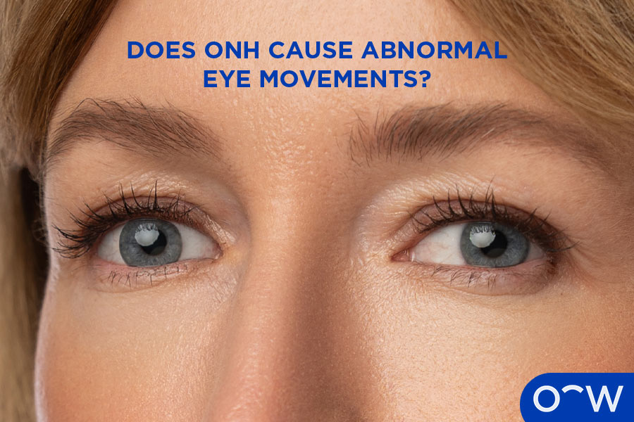 A person’s left eye affected by ONH appears off-centre