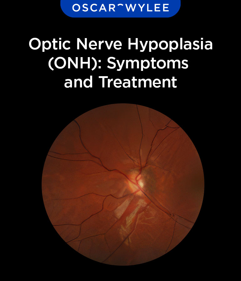 Optic Nerve Hypoplasia (ONH): Symptoms and Treatment