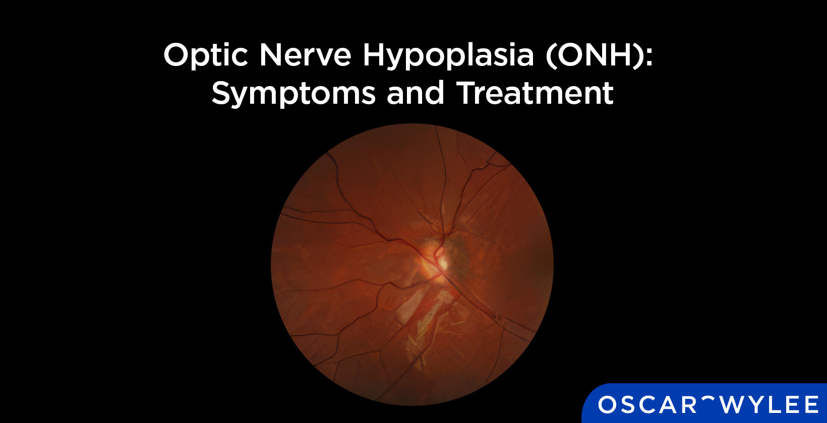 Optic Nerve Hypoplasia (ONH): Symptoms and Treatment