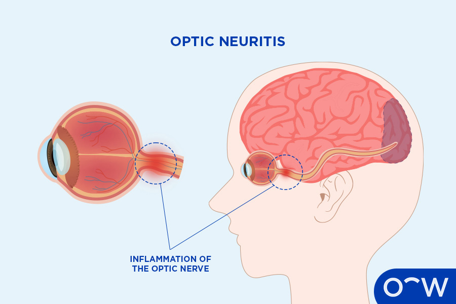 Graphic exhibiting the inside of the eye, revealing the optic nerve and how it connects from the eyes to the brain.