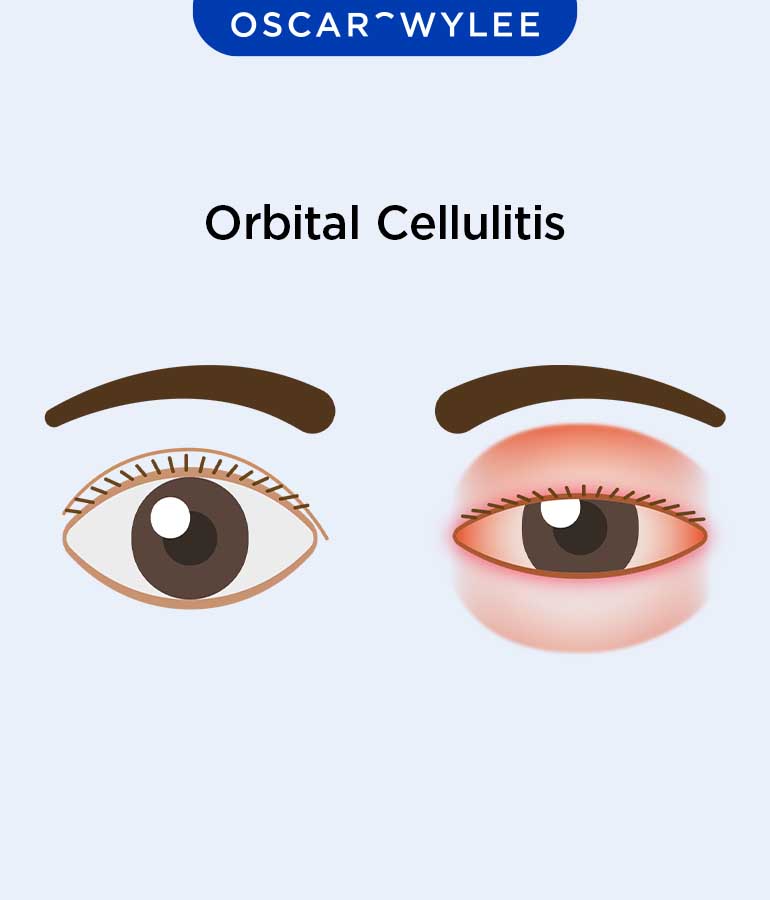 Orbital Cellulitis: Infection, Treatment, and Stages