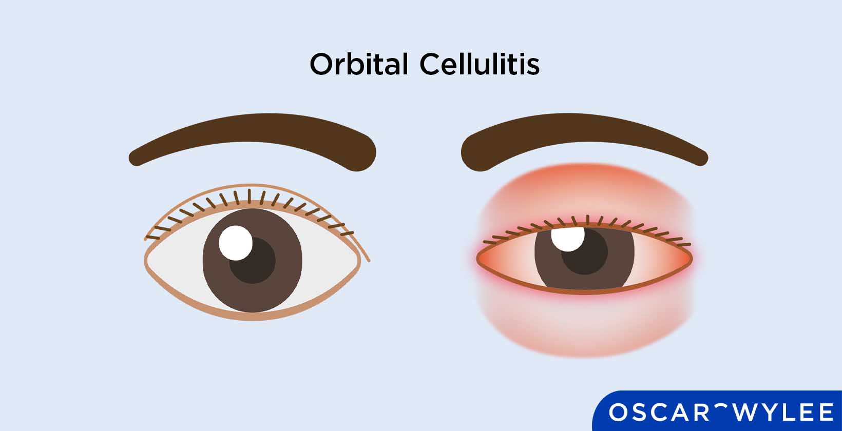 Orbital Cellulitis: Infection, Treatment, and Stages