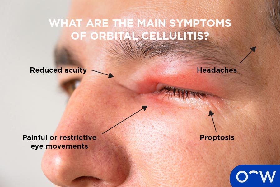 An infographic with symptoms of Orbital Cellulitis: painful or restrictive eye movements, reduced acuity, proptosis and headaches.