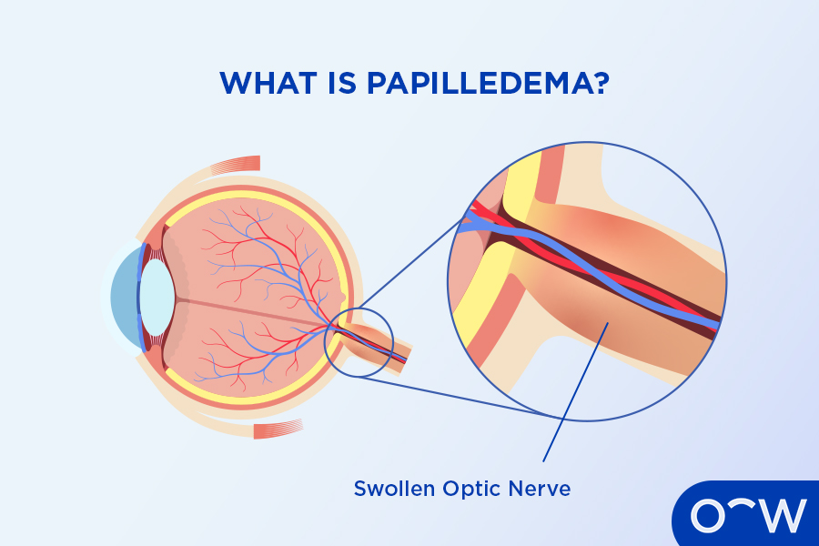 A cross-section of an eye next to a close-up of the optic nerve, which is swollen, demonstrating papilledema.