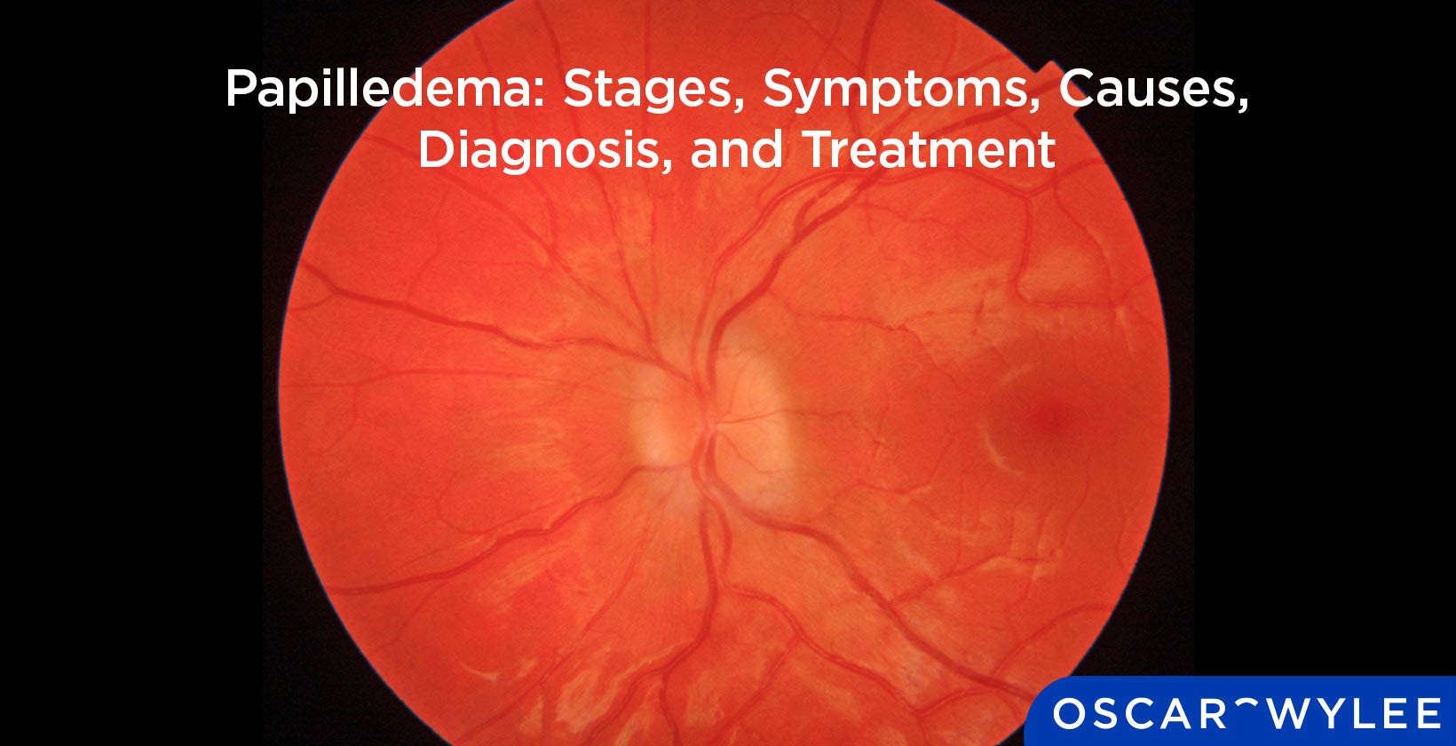 Papilledema