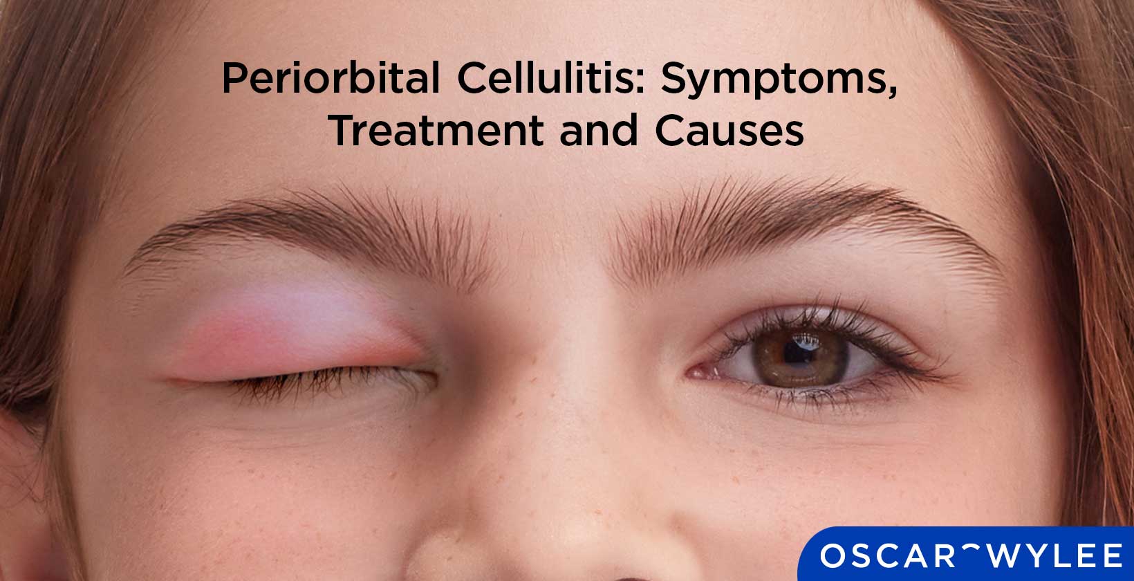 Periorbital Cellulitis: Symptoms, Treatment and Causes