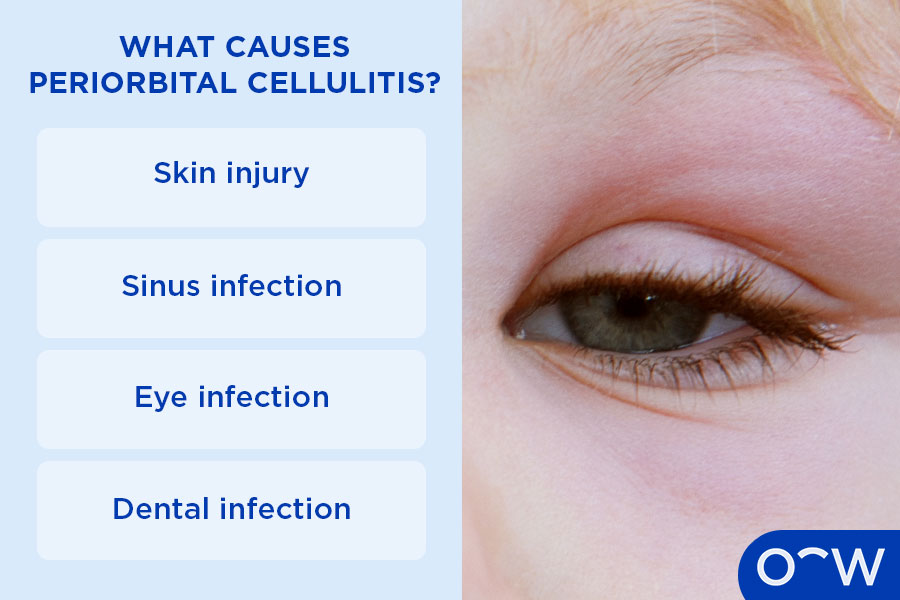 Infographic outlining periorbital cellulitis causes