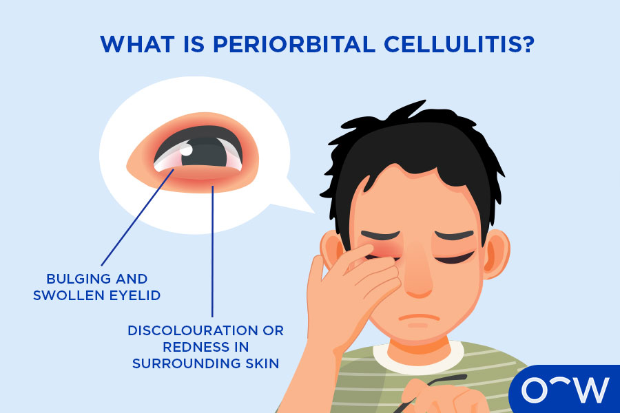 Labelled graphic explaining what periorbital cellulitis is on a child