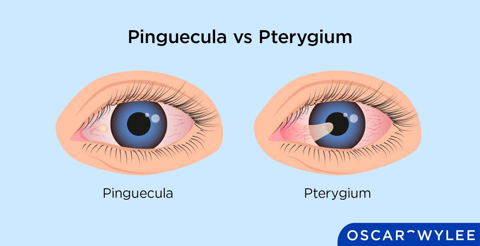 Pinguecula vs Pterygium