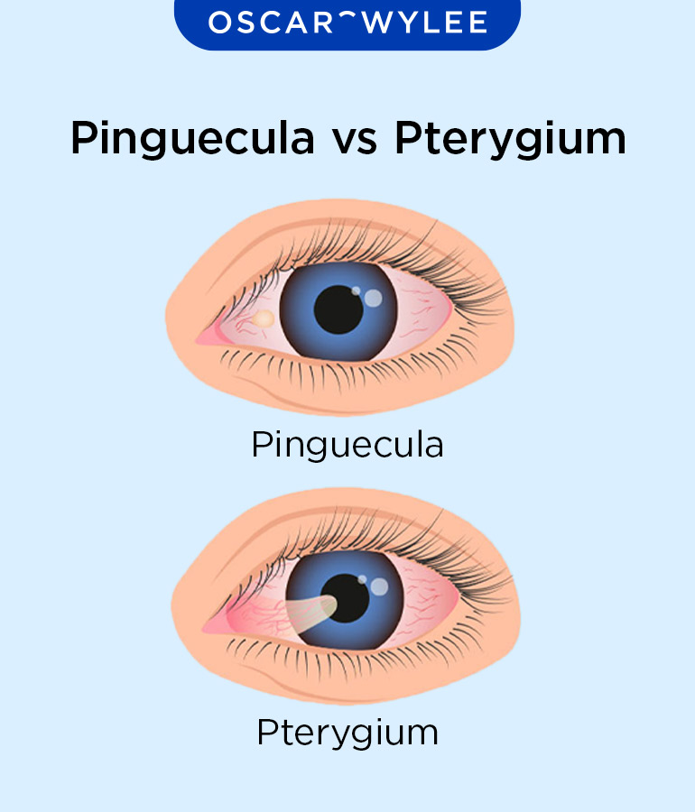 Pinguecula vs Pterygium
