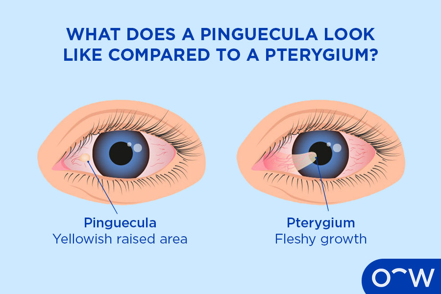 Labelled image comparing a Pinguecula to a Pterygium.