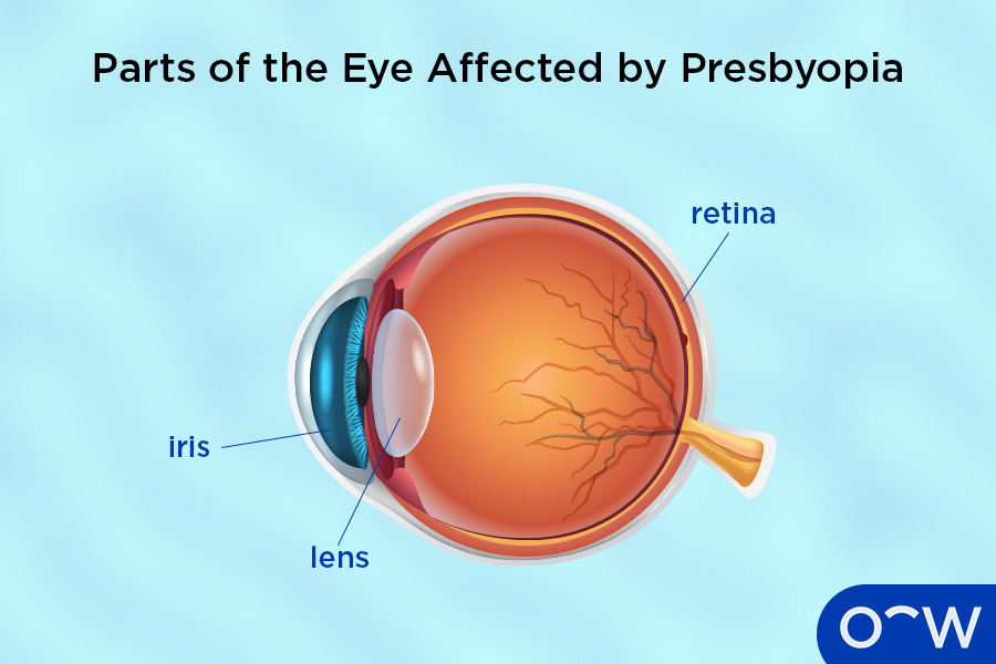 A labelled eye with presbyopia